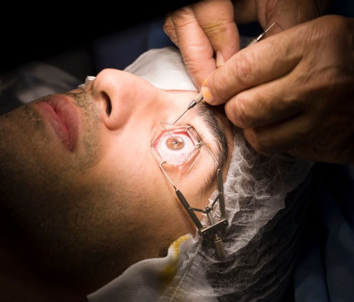 LASIK eye surgery