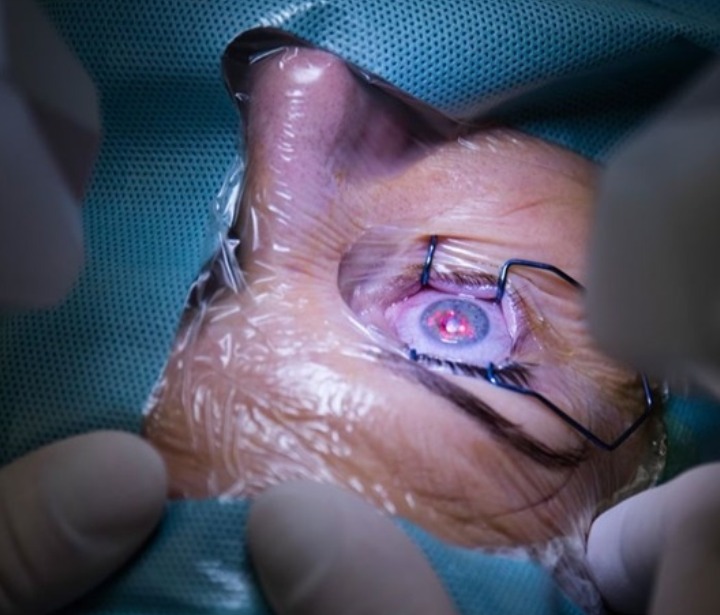 Cornea Surgery in Delhi