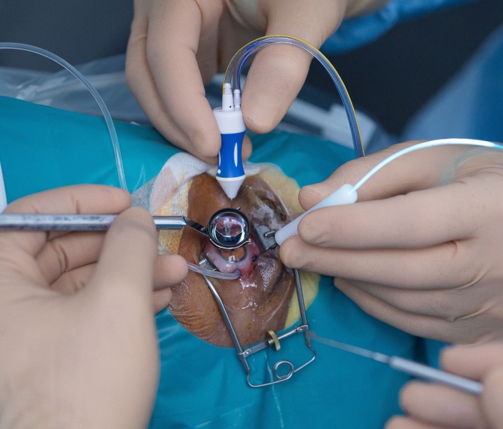 Retina Surgery in Delhi