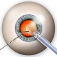 Micro Incision Cataract Surgery