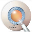 Phacoemulsification Cataract Surgery