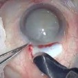 Small Incision Cataract Surgery