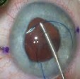 Scleral fixated IOL implants