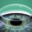 Corneal Transplantation