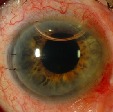 Lamellar Keratoplasty