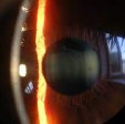 Slit Lamp Photography
