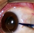 Eye muscle Surgery