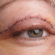 Eyelid surgery
