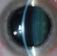 Implantable Contact Lens (ICL)