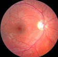 Optic Nerve Head (Optic Disc) Photography