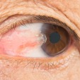 Pterygium Surgery
