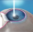 Refractive surgery (LASIK, PRK)