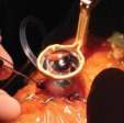 MIVS (Micro Incision Vitrectomy Surgery)