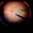 Ultra-High Speed Vitrectomy