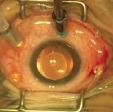 Bimanual Diabetic Vitrectomy