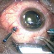 Bimanual Vitreo-Retinal Surgery