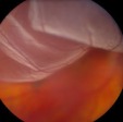 Retinal Detachment Surgery