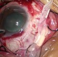 Scleral Buckling Surgery