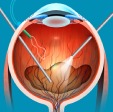 Vitreoretinal surgery