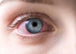 Red Eyes Treatment in Delhi NCR