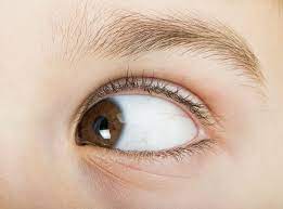 Strabismus Treatment in Delhi NCR