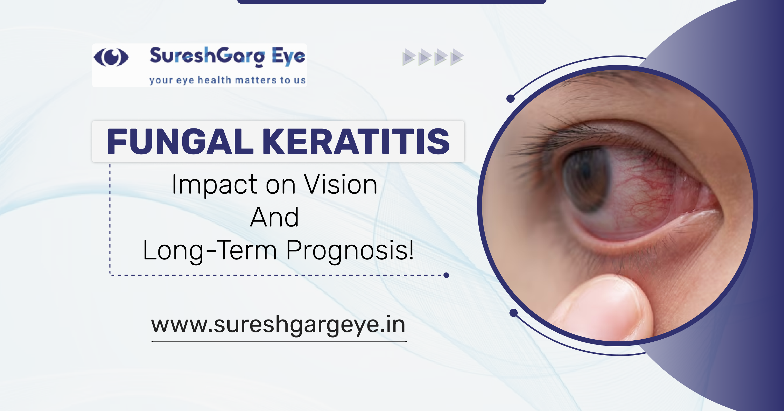 Fungal Keratitis: Impact on Vision and Long-Term Prognosis!