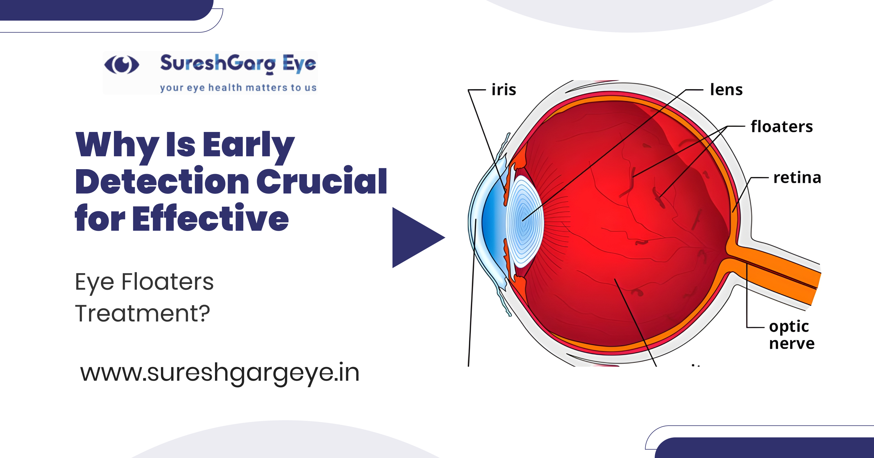 Why Is Early Detection Crucial for Effective Eye Floaters Treatment?